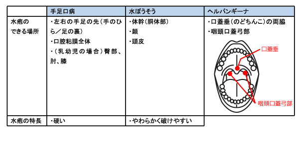 水疱瘡 手足 口 病